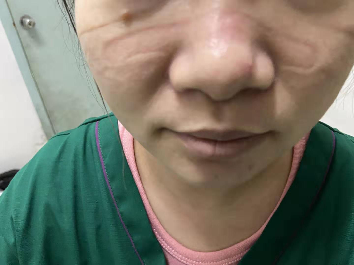 小伤口导致截肢……这个3岁孩子身上到底发生了什么__中国医疗